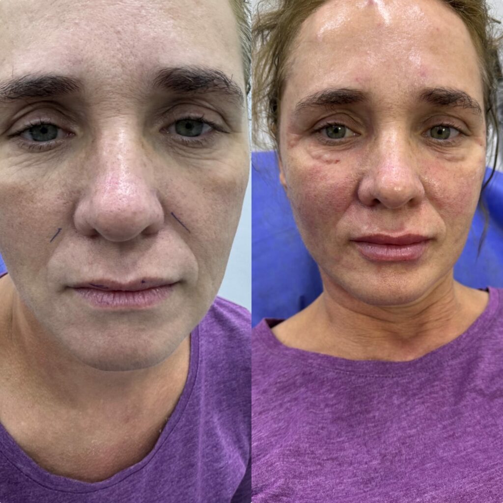 فيلر غير مرئي Undetectable في الغردقة